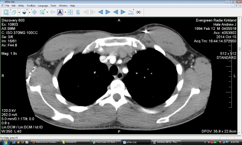 Perfectly clear lungs and no lymph node growth :D